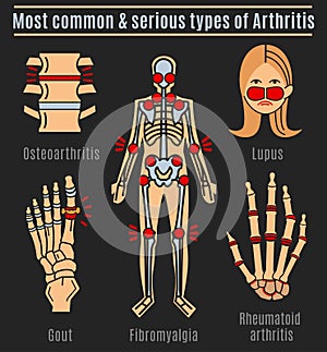 Arthritis types infographic