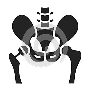 Arthroplasty glyph black icon. Hip replacement implant installed in the pelvis bone. Isolated vector element