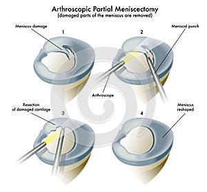 Arthroscopic Partial Meniscectomy