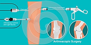 Arthroscopy medical treatment surgery photo