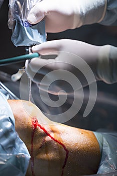 Arthroscopy orthopedic surgery knee arthroscope probe photo