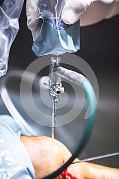 Arthroscopy orthopedic surgery knee arthroscope probe photo