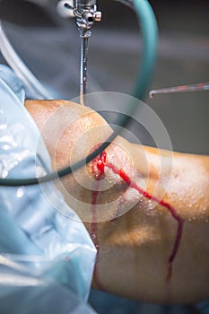 Arthroscopy orthopedic surgery knee arthroscope probe photo