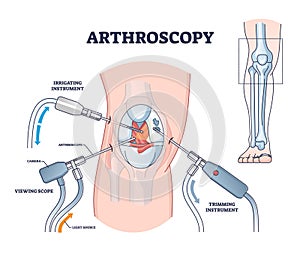 Arthroscopy procedure as knee diagnostics process explanation outline diagram