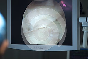 Arthroscopy surgery screen photo