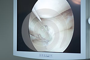 Arthroscopy surgery screen photo