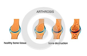 Arthrosis. bone destruction
