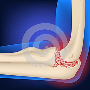 Arthrosis of the elbow joint. Illustration of hand bones on a neon blue background