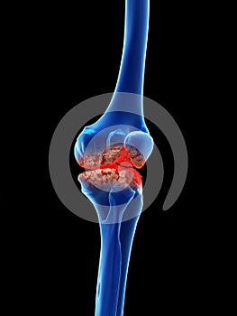 Arthrosis in the knee