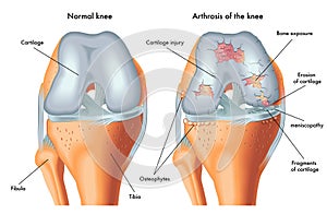 Arthrosis of the knee photo