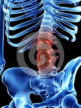 Arthrosis in the lumbar spine photo