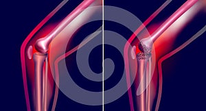 Arthrosis medical illustration diagram with damaged knee structure and healthy knee comparison.