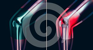 Arthrosis medical illustration diagram with damaged knee structure and healthy knee comparison.