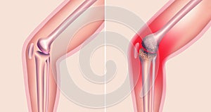 Arthrosis medical illustration diagram with damaged knee structure and healthy knee comparison.