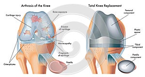 Arthrosis medical illustration  photo