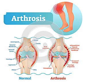 Arthrosis medical vector illustration diagram with damaged knee structure and healthy knee comparison.