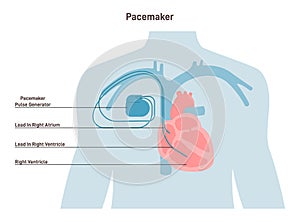 Artificial cardiac pacemaker anatomical scheme. Medical device