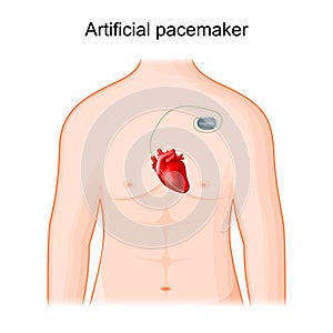 Artificial cardiac pacemaker. Human heart