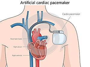 Artificial cardiac pacemaker medical device