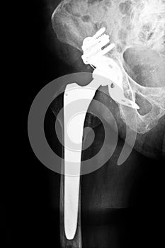 Artificial hip joint