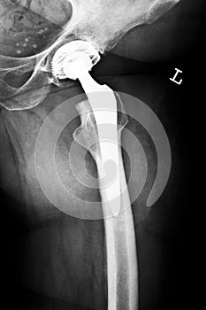 Artificial hip joint