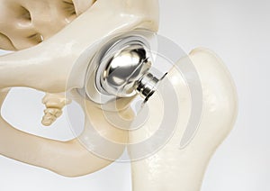 Artificial hip joint after femoral neck fracture - 3D Rendering