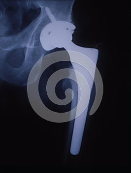 Artificial hip joint in the human thigh