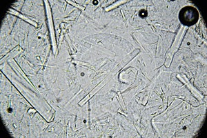 Artificial honey with large rectangular sugar crystals under microscope. Natural honey mixed with sugar syrup