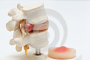 Artificial human herniated lumbar disc on white background