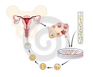 Artificial insemination. In vitro fertilization. Illustration photo
