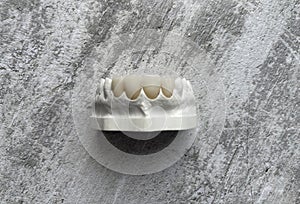 Artificial jaw with veneers and crowns.