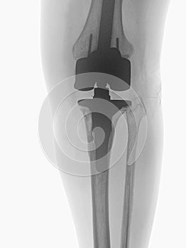 Artificial knee joint