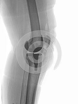 Artificial knee joint