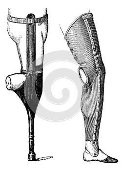 Artificial Legs for Below-knee Amputation, vintage engraving