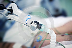 Artificial lung ventilation tube connected to the patient in the