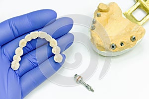 Artificial teeth in the dentist`s hand. ceramic dental bridge for prosthetics on dental implants. unscrewed dental abutment