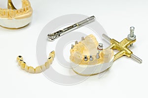 artificial teeth on implants. jaw model with dental implants. a screwdriver is inserted into the abutment