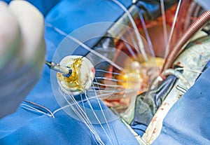 Artifitial heart valve implantation