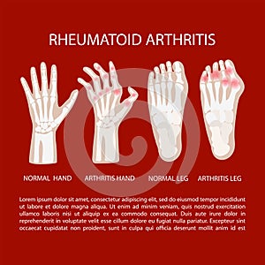ARTRITIS LEG HAND Rheumatoid Medicine Education Vector Scheme photo