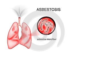 Asbestos lung disease