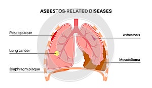 Asbestos related diseases