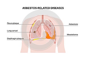 Asbestos related diseases