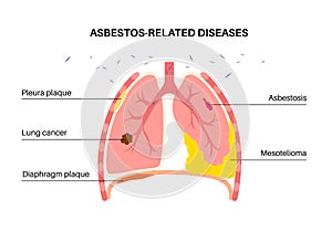 Asbestos related diseases