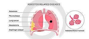 Asbestos related diseases