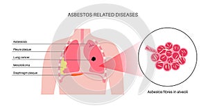 Asbestos related diseases