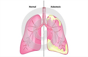 Asbestosis on human lung