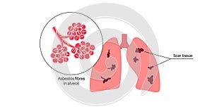 Asbestosis lung disease