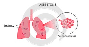 Asbestosis lung disease