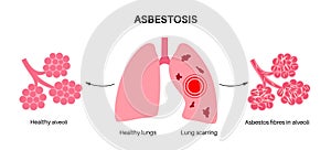 Asbestosis lung disease