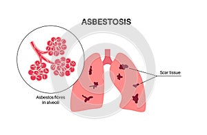 Asbestosis lung disease